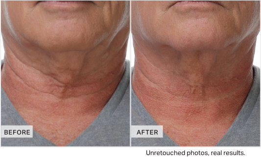 Before and after comparison of neck skin texture on a person wearing a gray shirt.
