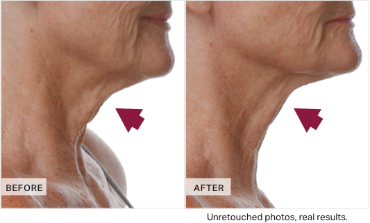 Before and after comparison of neck skin texture with arrows pointing to differences.