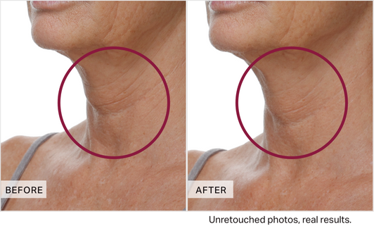 Before and after comparison of neck skin texture with a circle highlighting the difference.