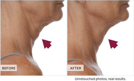 Before and after comparison of neck skin texture with arrows pointing to differences.
