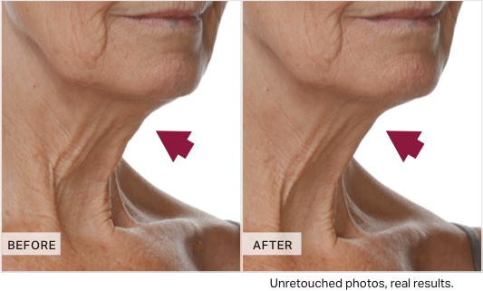 Before and after comparison of neck skin texture with arrows pointing to differences.
