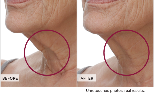 Before and after comparison of neck skin texture with a focus on wrinkles.