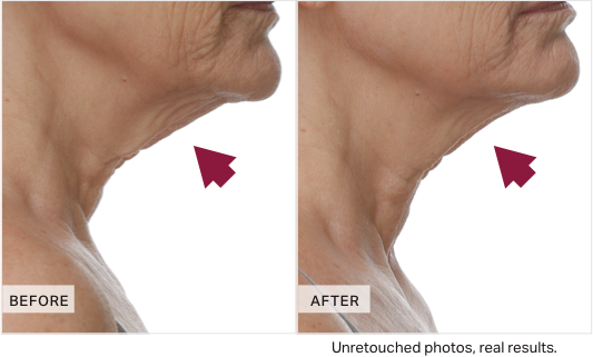 Before and after comparison of neck skin texture with arrows pointing to areas.