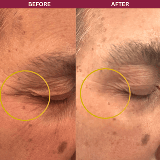 Before and after comparison of a person's eye area with a yellow circle highlighting the difference.