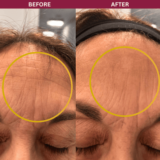 Before and after comparison of forehead skin texture with a yellow circle highlighting the difference.