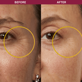 Before and after comparison of eye area with a focus on skin texture.