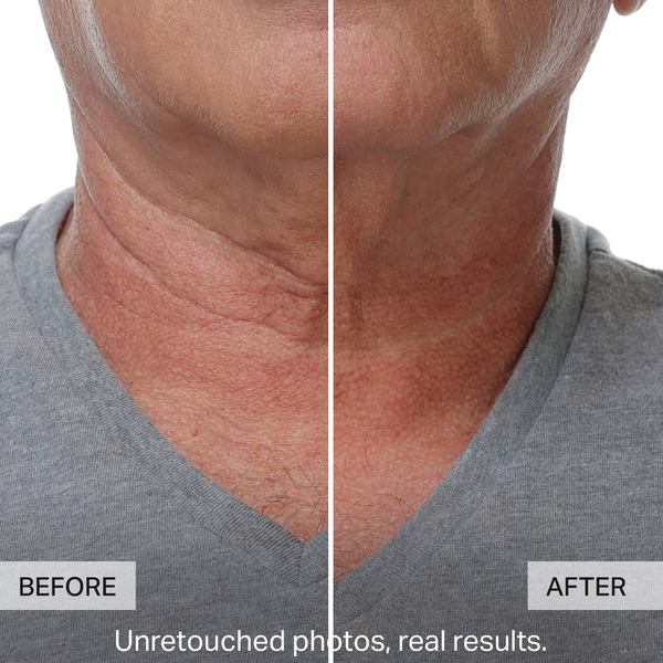 Before and after comparison of neck skin texture on a person wearing a gray shirt.
