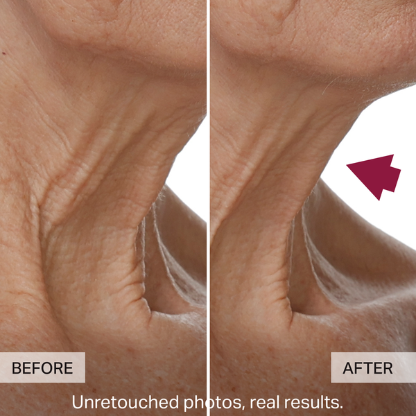 Before and after comparison of skin texture with an arrow pointing to the 'AFTER' side.