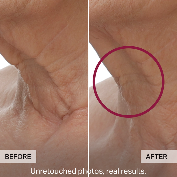 Before and after comparison of skin texture with a purple circle highlighting improvement.