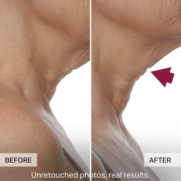 Before and after comparison of skin texture on a person's shoulder.