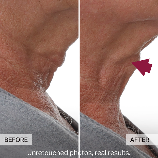 Before and after comparison of neck skin texture with a red arrow pointing to the 'AFTER' side.