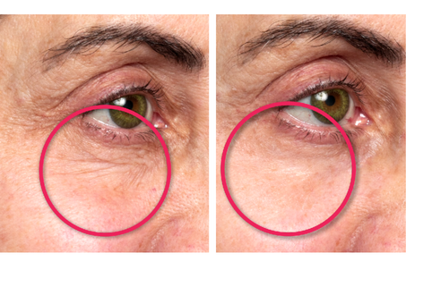 Before and after comparison of eye area with visible wrinkles.