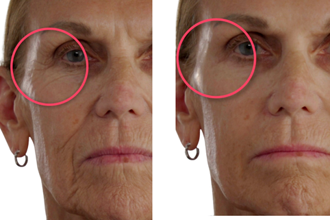Before and after comparison of a woman's face with visible aging signs.