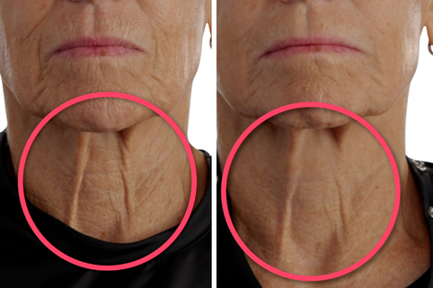 Before and after comparison of a person's neck area with visible wrinkles, highlighted by pink circles.