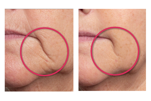 Before and after comparison of skin texture on a person's cheek with a pink circle highlighting the difference.