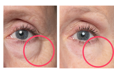 Before and after comparison of eye area with a red circle highlighting a wrinkle.