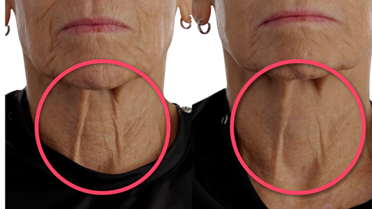 Close-up of a person's neck with visible wrinkles, circled in pink.