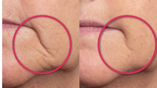 Before and after comparison of skin texture on a person's cheek.