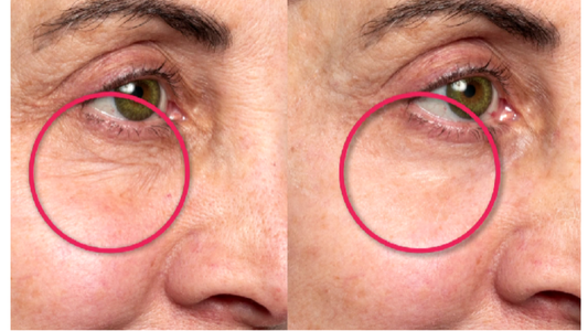 Before and after comparison of eye area with red circles highlighting differences.