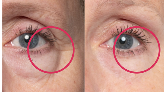 Before and after comparison of eye area with visible aging signs.