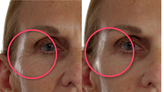 Before and after comparison of a woman's eye area with a pink circle highlighting the difference.