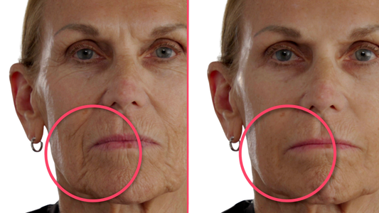 Before and after comparison of a woman's face with a focus on wrinkles.