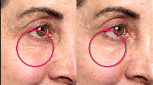 Before and after comparison of eye area with visible wrinkles.