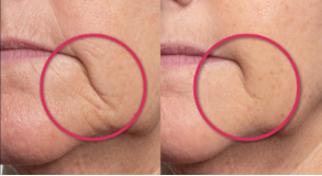 Close-up of lips with a red circle highlighting a mole on the left side.