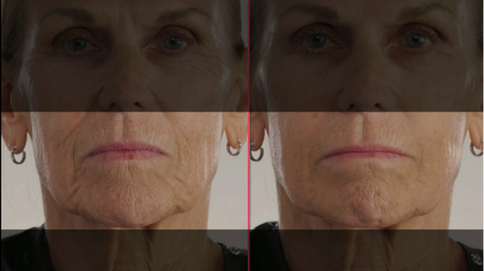 Before and after comparison of a woman's face with visible aging effects.