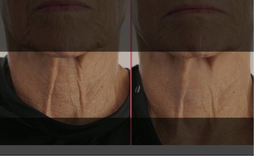 Before and after comparison of neck skin texture on a person wearing a black shirt.
