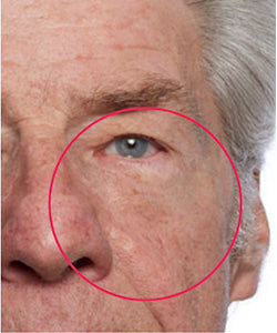 Under-Eye Bags after