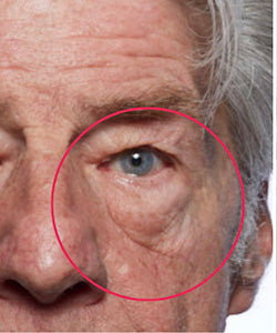 Under-Eye Bags before