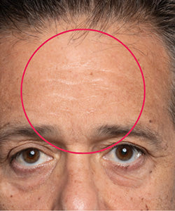 Forehead Lines after