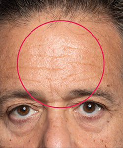 Forehead Lines before
